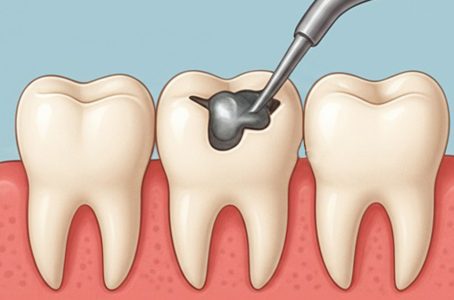Say Goodbye to Cavities: How Dental Fillings Can Help