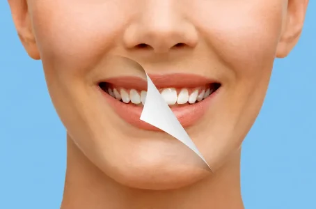 Teeth Whitening in Grimsby for Sensitive Teeth